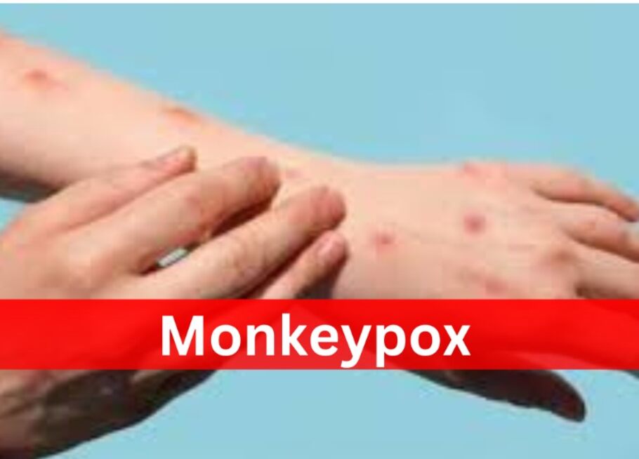 Monkey Pox: भारत के करीब पहुंचा मंकी पॉक्स..जानिए लक्षण और इससे बचने के उपाय